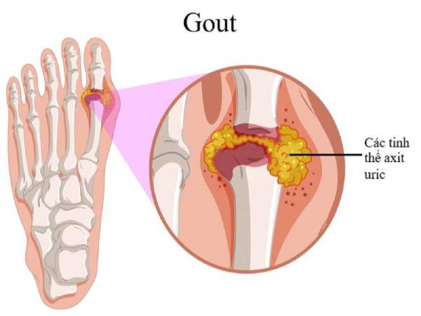 Gout là gì?