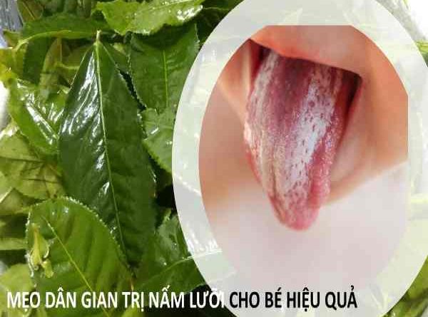 Tổng hợp mẹo chữa nấm miệng cho trẻ không gây kích ứng